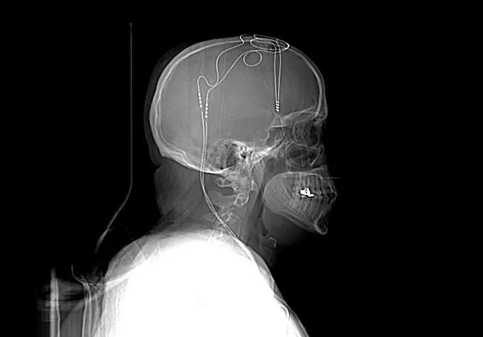 Kỹ thuật cấy ghép điện não