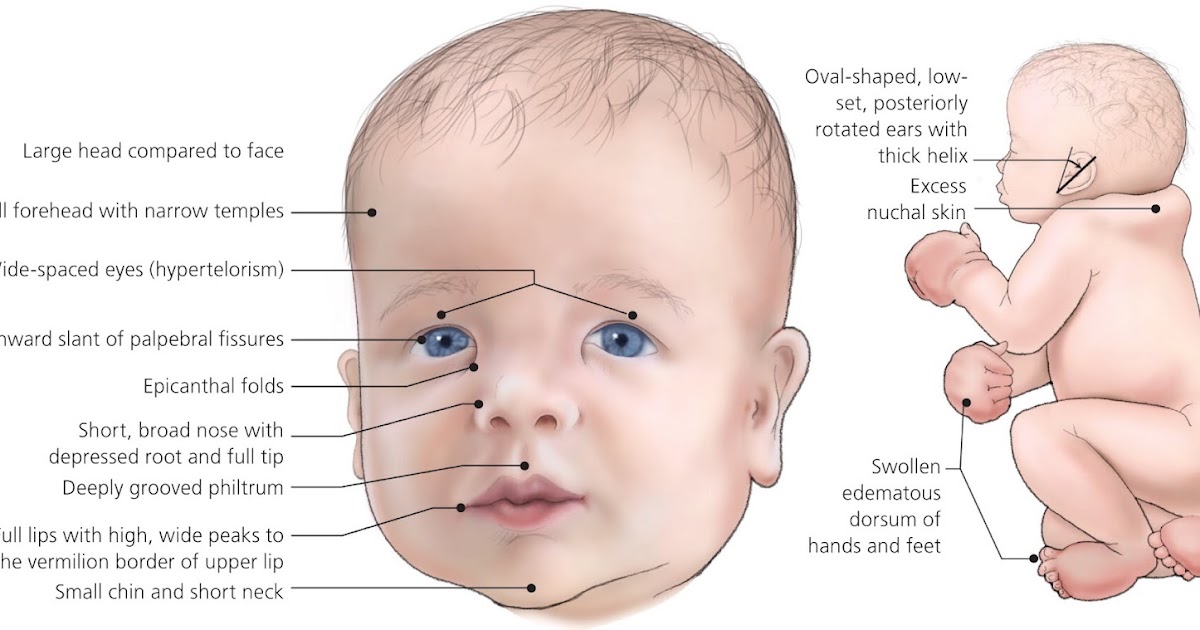 Đặc điểm khuôn mặt của trẻ mắc hội chứng rượu bào thai (FASD)